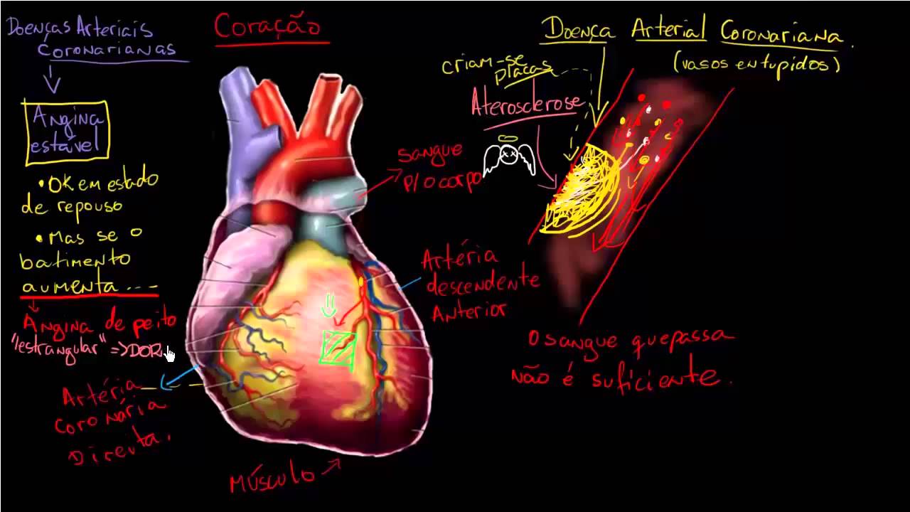 Doença Arterial Coronariana: O que é e como prevenir?